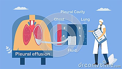Pleural effusion is collection of excess fluid between layers of pleura outside lungs. Pulmonology vector illustration about Vector Illustration