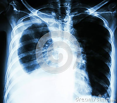 Pleural effusion due to lung cancer Stock Photo