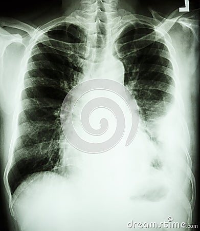 Pleural effusion at left lung due to lung cancer Stock Photo