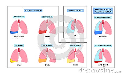 Pleural effusion poster Vector Illustration