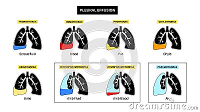 Pleural effusion poster Vector Illustration