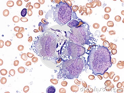 Pleural lymphoma, Cytology. Stock Photo