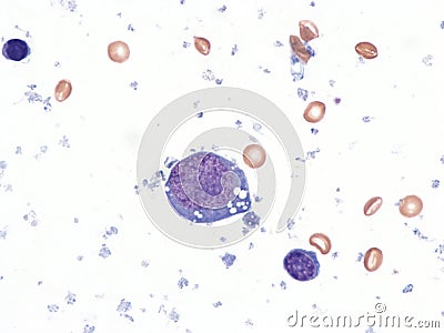 Pleural lymphoma, Cytology. Stock Photo