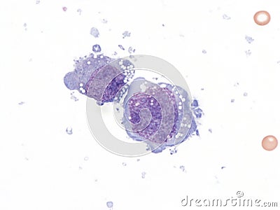 Pleural lymphoma, Cytology. Stock Photo