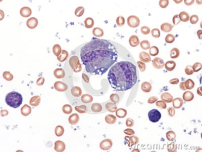 Pleural lymphoma, Cytology. Stock Photo