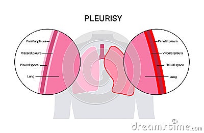 Pleurisy inflammation diseases Vector Illustration