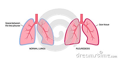 Pleurodesis medical procedure Vector Illustration