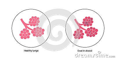 Pneumoconiosis lung disease Vector Illustration