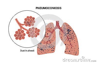 Pneumoconiosis lung disease Vector Illustration