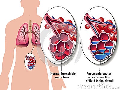 Pneumonia Vector Illustration