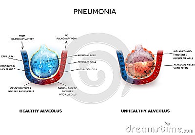 Pneumonia and healthy alveoli Vector Illustration