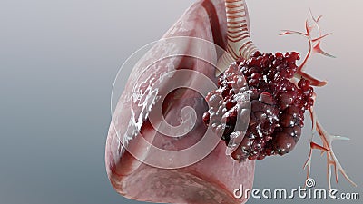 Pneumonia illness, healthy lungs and disease lungs, Human Lungs cancer, Cigarette smokers, cancerous malignant tumor Stock Photo