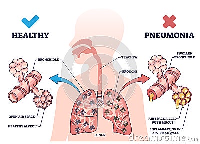 Pneumonia illness medical comparison with healthy lungs outline diagram Vector Illustration