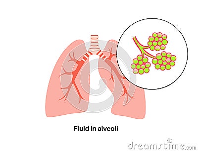 Pneumonia infection poster Vector Illustration