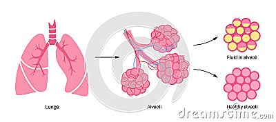 Pneumonia infection poster Vector Illustration