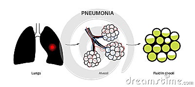 Pneumonia infection poster Vector Illustration