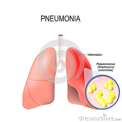 Pneumonia. Normal and inflammatory condition of the lung. Vector Illustration