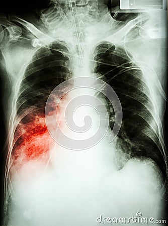 Pneumonia with respiratory failure Stock Photo