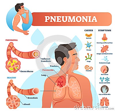 Pneumonia vector illustration. Labeled diagram with causes and symptoms. Vector Illustration