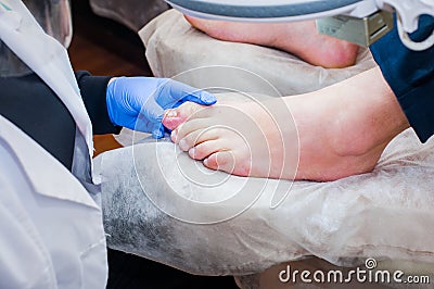 Podology treatment. Podiatrist treating toenail fungus. Doctor removes calluses, corns and treats ingrown nail. Hardware manicure. Stock Photo