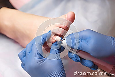 Podology treatment. Podiatrist treating toenail fungus. Doctor removes calluses, corns and treats ingrown nail. Hardware Stock Photo