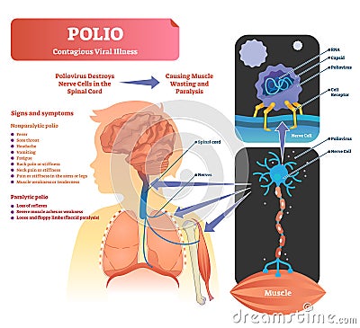 Polio vector illustration. Labeled medical virus infection symptoms scheme. Vector Illustration