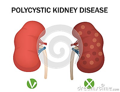 Polycystic kidney disease and healthy kidney. medical infographics. Vector illustration Cartoon Illustration