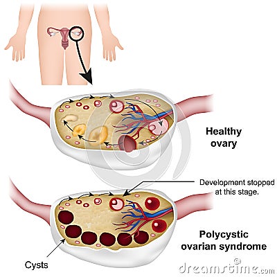 Polycystic ovarian syndrome medical illustration Cartoon Illustration