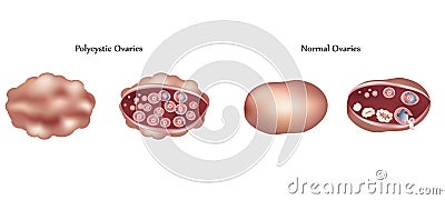 Polycystic ovaries Vector Illustration