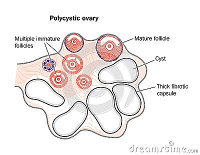 Polycystic ovary