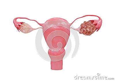Polycystic Ovary Syndrome A hormonal disorder that causes an increase in the size of the ovaries with small cysts on the outside Cartoon Illustration