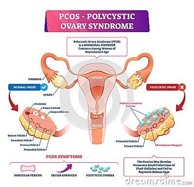 Polycystic ovary syndrome vector illustration. Labeled reproductive disease Vector Illustration