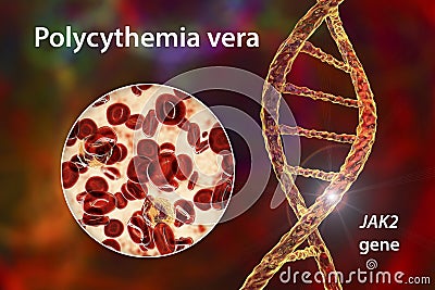 Polycythemia vera, a rare slow-growing blood cancer with an increase in the number of red blood cells Cartoon Illustration
