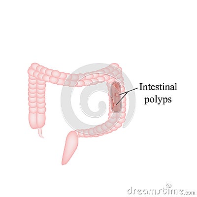 Polyp in the intestine. Polyp in the colon. Vector Vector Illustration