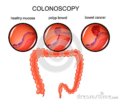 Polyp of the large intestine and cancer Vector Illustration