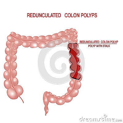 Polyp with stalk. Redunculated. Concept.Vector realistic illustration. Vector Illustration