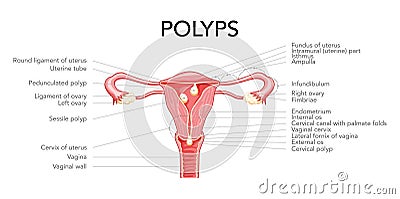 Polyp in the uterus with inscriptions diagram Female reproductive system in cross sections. Front view in a cut. Human Vector Illustration