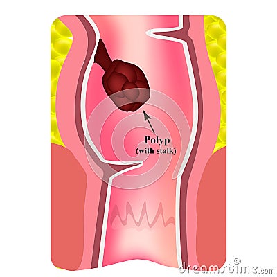 Polyps in the rectum. The structure of the rectum of the intestine. Types of polyps in the colon. Infographics. Vector Vector Illustration
