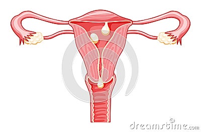 Polyps in the uterus - cervical, pedunculated and sessile Female reproductive system in cross sections. Front view Vector Illustration