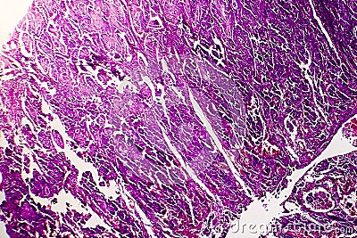 Poorly differentiated intestinal adenocarcinoma , light micrograph Stock Photo