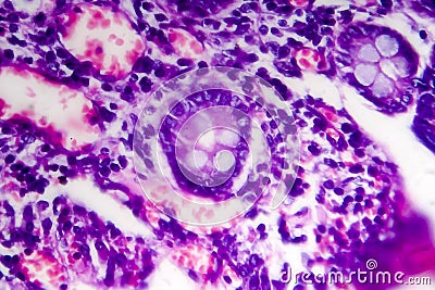 Poorly differentiated intestinal adenocarcinoma , light micrograph Stock Photo