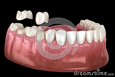 Porcelain crowns placement over premolar and molar teeth. . Medically accurate 3D illustration Cartoon Illustration