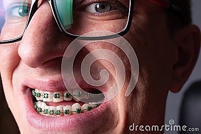 Portrait of a man with crooked teeth and metal braces with green rubber bands close-up. Young man with dental orthodontic braces Stock Photo