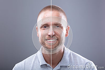 Man`s Face Before And After Cosmetic Procedure Stock Photo