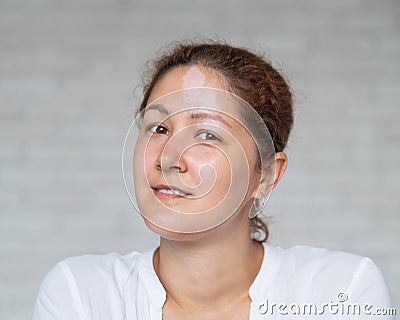 Portrait of a smiling woman with a pigmented spot on her forehead. Girl with Vitiligo Disease. Stock Photo