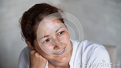 Portrait of a smiling woman with a pigmented spot on her forehead. Girl with Vitiligo Disease. Stock Photo