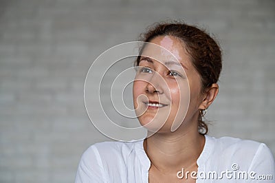 Portrait of a smiling woman with a pigmented spot on her forehead. Girl with Vitiligo Disease. Stock Photo