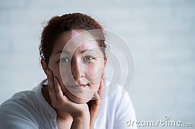 Portrait of a smiling woman with a pigmented spot on her forehead. Girl with Vitiligo Disease. Stock Photo