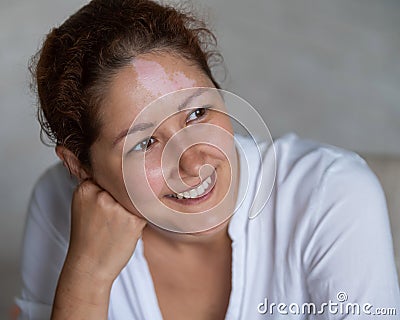 Portrait of a smiling woman with a pigmented spot on her forehead. Girl with Vitiligo Disease. Stock Photo