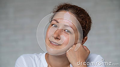 Portrait of a smiling woman with a pigmented spot on her forehead. Girl with Vitiligo Disease. Stock Photo